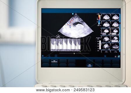 On The Screen Of An Ultrasound Machine Is An Image Of A Saggital Scan Of The Brain, Passing Through 