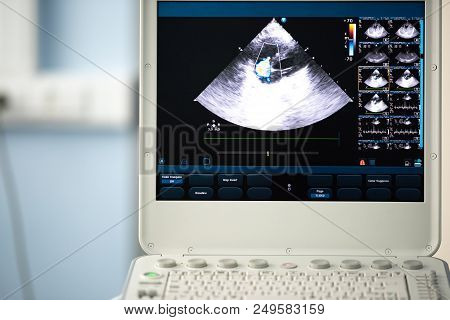 On The Screen Of An Ultrasound Device, A Heart Scan In A Four-chamber Position With A Doppler Image 