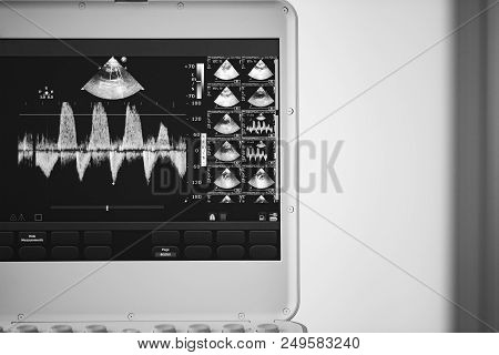 The Screen Of The Apparatus For Ultrasound Examination Showing The Measurement Of The Pressure Gradi
