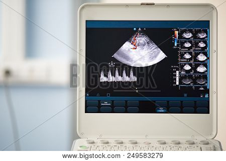 On The Screen Of An Ultrasound Machine, A Saginal Scan Of The Brain With Visualization Of The Cerebr