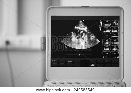 On The Screen Of A Modern Ultrasound Scanner, An Image Of The Heart Cavities With Red And Blue Strea