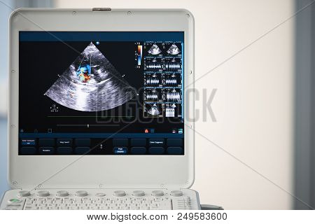 On The Screen Of A Modern Ultrasound Scanner, An Image Of The Heart Cavities With Red And Blue Strea