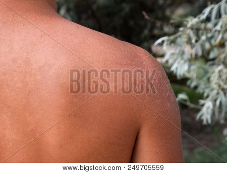 Sunburn On The Skin Of The Back. Exfoliation, Skin Peels Off. Dangerous Sun Tan
