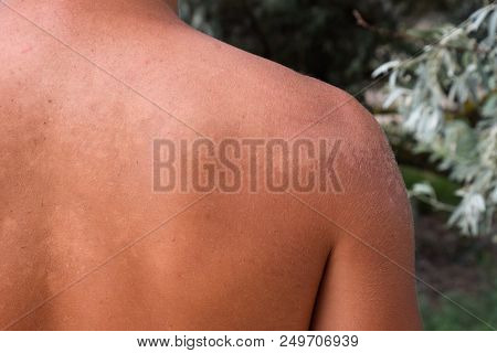 Sunburn On The Skin Of The Back. Exfoliation, Skin Peels Off. Dangerous Sun Tan