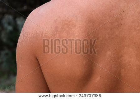 Sunburn On The Skin Of The Back. Exfoliation, Skin Peels Off. Dangerous Sun Tan