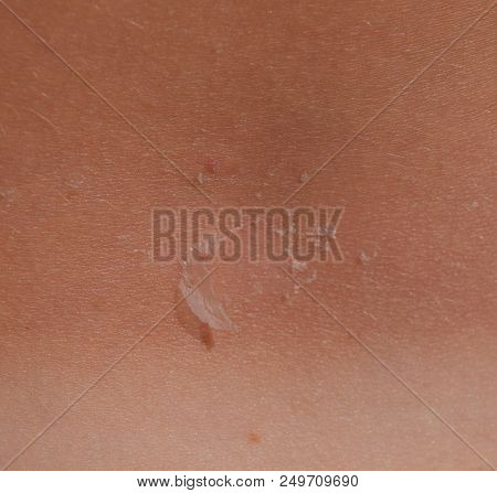 Sunburn On The Skin Of The Back. Exfoliation, Skin Peels Off. Dangerous Sun Tan