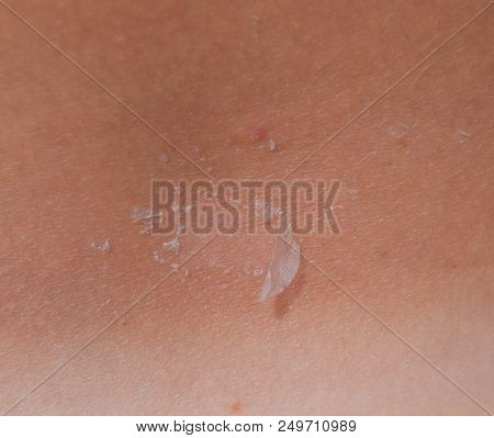 Sunburn On The Skin Of The Back. Exfoliation, Skin Peels Off. Dangerous Sun Tan