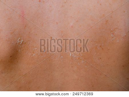 Sunburn On The Skin Of The Back. Exfoliation, Skin Peels Off. Dangerous Sun Tan