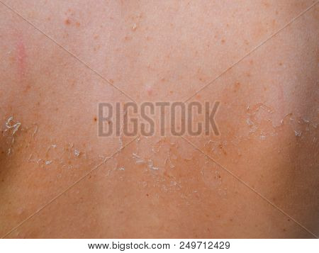 Sunburn On The Skin Of The Back. Exfoliation, Skin Peels Off. Dangerous Sun Tan