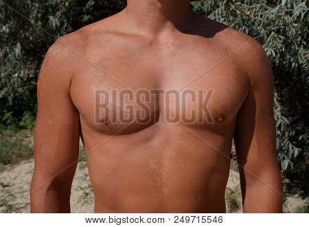 Sunburn On The Skin Of The Chest And Abdomen Of A Man. Exfoliation, Skin Peels Off. Dangerous Sun Ta