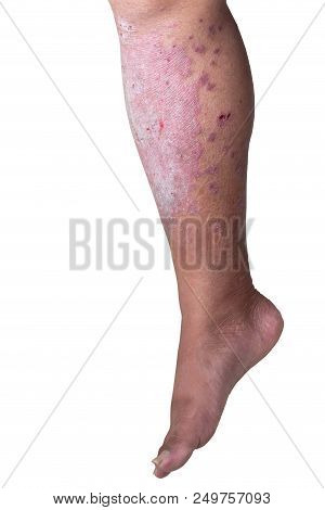 The Man's Leg Is Filled With Psoriasis With Clipping Paths
