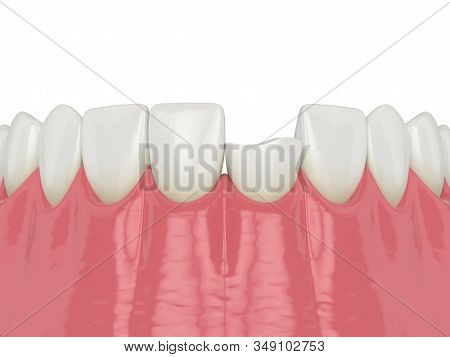 3d Render Of Lower Jaw With Broken Incisor Tooth Over White Background