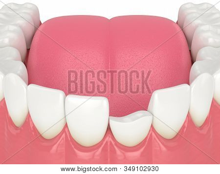 3d Render Of Lower Jaw With Broken Incisor Tooth Over White Background