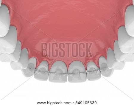 3d Render Of Dental Bonded Retainer On Upper Jaw Over White Background