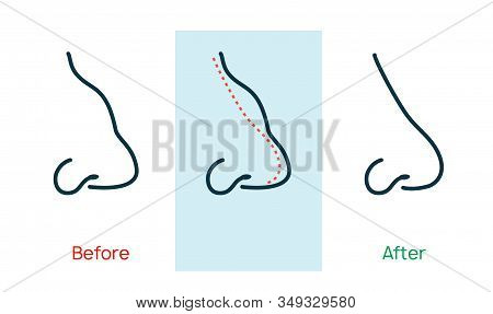 Rhinoplasty Nose Plastic Surgey Icon. Vector Rhinoplasty Beauty Icon