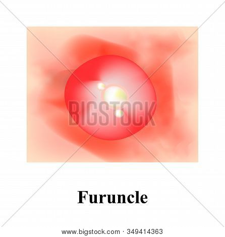 Pustules On The Skin. Cystic Acne. Pimples On The Skin. Furuncle. Infographics. Illustration.