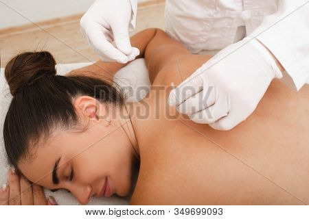 Woman On Acupuncture Procedure For The Treatment Of Back Traditional Chinese Medicine