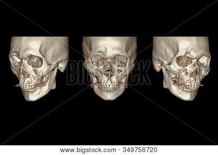 CT Facial Bone 3D rendering  image isolated on black background showing fracture frontal bone .
