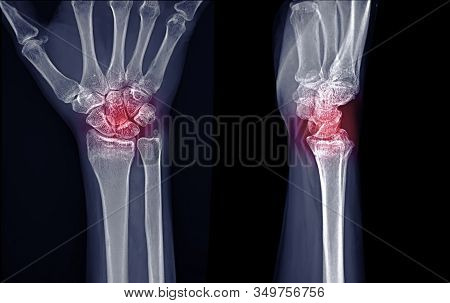 X-ray Image Of Right Wrist Joint Ap And Lateral View