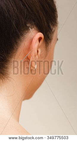 Acupuncture Treatment For Tobacco Or Alcohol Addiction. Traditional Chinese Medicine Will Help Get R