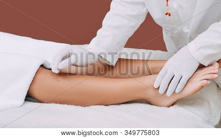 Reflexologist Doing Acupuncture To The Patient. Needle Therapy Helps Patients Get Rid Of Many Diseas