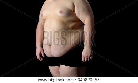 View To Fat Belly Man, Metabolic Disorder, Stomach Resection, Liposuction