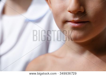 Close-up Of A Small Boy With Herpes On The Lip, A Boy At A Doctors Office Dermatologist With Skin Pr