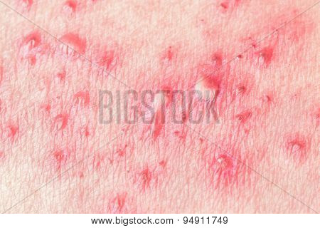 Herpes Zoster (shingles)