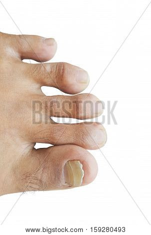 Closeup man's toe nails are going to fall isolated on white background.
