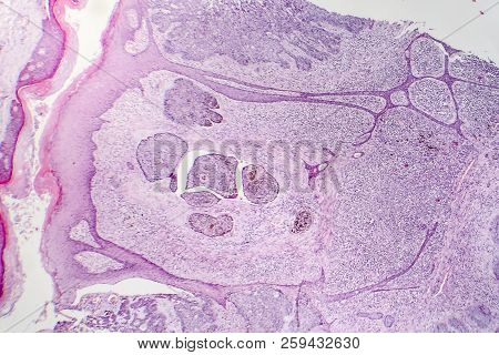 Basal Cell Carcinoma, Skin Cancer, Light Micrograph, Photo Under Microscope