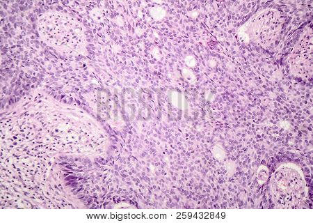 Basal Cell Carcinoma, Skin Cancer, Light Micrograph, Photo Under Microscope