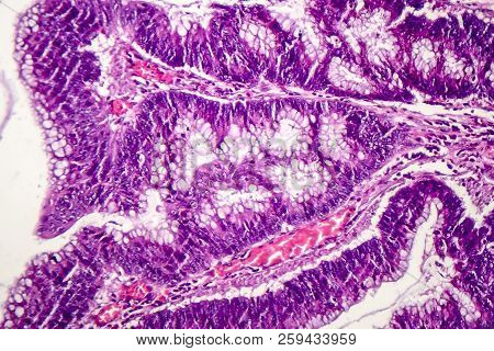 Colon Adenocarcinoma, Light Micrograph, Photo Under Microscope
