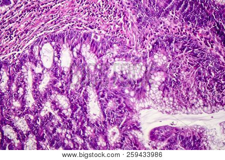 Colon Adenocarcinoma, Light Micrograph, Photo Under Microscope