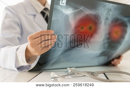 Lung Cancer. Doctor Radiology Check Up Xray Image Have Problem Lung Tumor Of Patient In Clinic Room.