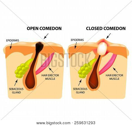 Types Of Acne. Open Comedones, Closed Comedones, Skin Structure. Infographics. Vector Illustration O