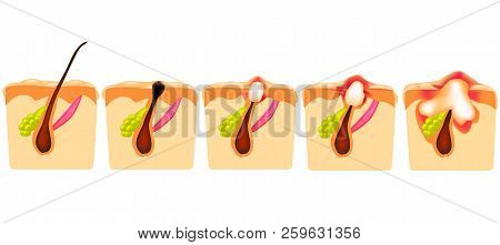Types Of Acne. Open Comedones, Closed Comedones, Inflammatory Acne, Cystic Acne. The Structure Of Th