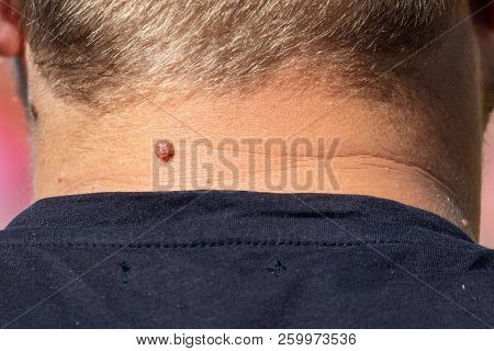 Birthmark On The Neck Of A Man .