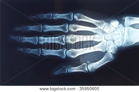 Xray