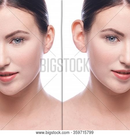 Girl Before And After Cosmetology Plastic Surgery. Problem Operation Result. Healthcare Patient Remo