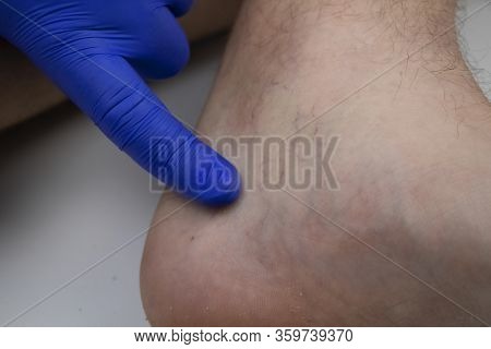 A Man In Consultation With A Vascular Surgeon. A Doctor Examines A Leg With Swollen Veins. Varicose