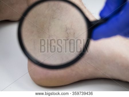A Man In Consultation With A Vascular Surgeon. A Doctor Examines A Leg With Swollen Veins. Varicose