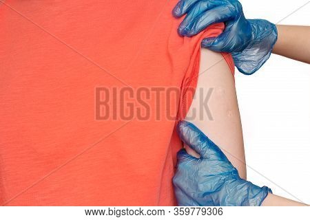 Doctor Or Nurse Examine Tuberculosis Vaccine Bcg Marks On The Shoulder Of An Adult Woman Made In Chi
