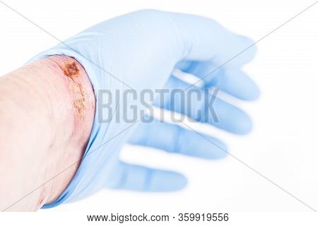 Chemical Burn On The Wrist Skin With Hydroxide Sodium Acid, By Striping Paint From Wood. Festering A