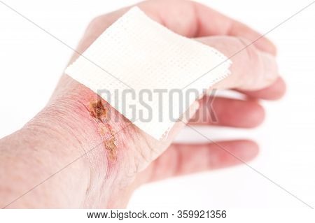 Chemical Burn On The Wrist Skin With Hydroxide Sodium Acid. Festering And Deep Wound. Household Acci