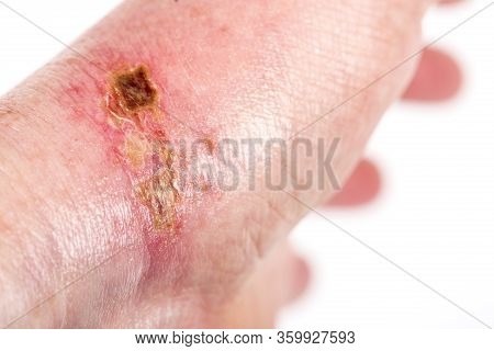 Chemical Burn On The Wrist Skin With Hydroxide Sodium Acid, By Striping Paint From Wood. Festering A
