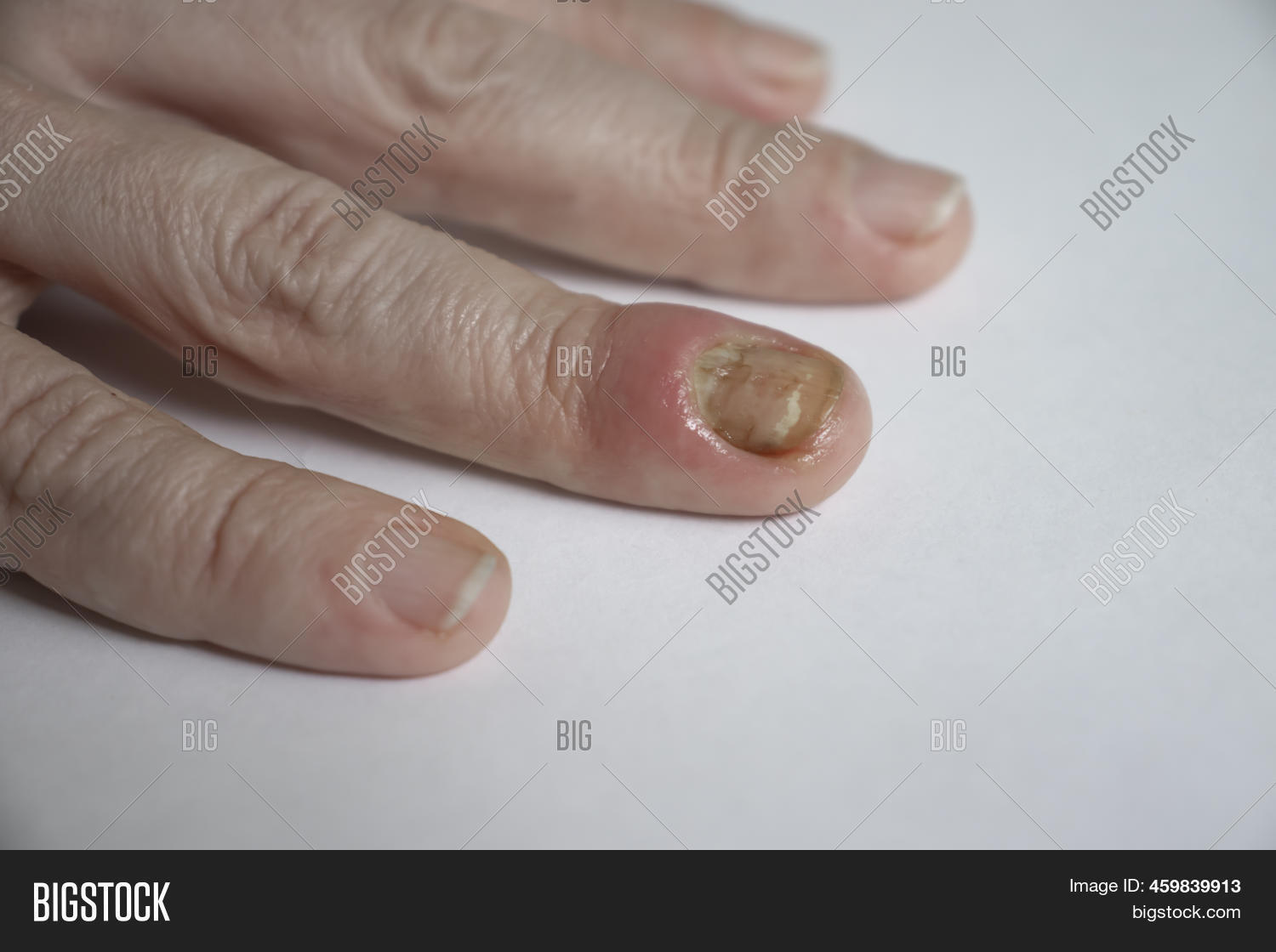 Paronychia Disease Image & Photo (Free Trial) Bigstock