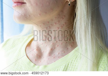 Real Biorevitalization Of The Skin On A White Background. Traces Of Injections Of Biorevitalization 