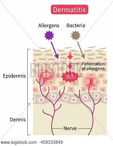 Atopic Dermatitis (eczema) Skin Disrupt Moisture Barrier That Allows Penetrate External Stimuli. Hea