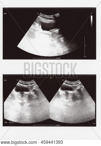 Full Abdomen Ultrasound Sonogram