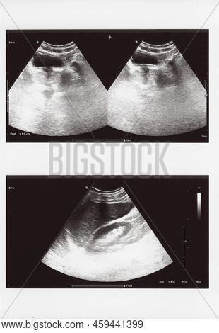 Full Abdomen Ultrasound Sonogram